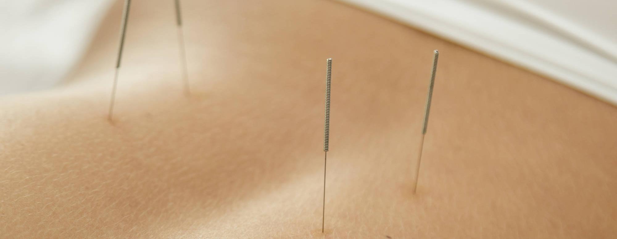 acupuncture-in-eythorne-kent.jpg